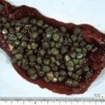 Cómo eliminar las piedras en los riñones de forma natural: guía completa para tu bienestar renal