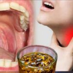 Adiós al Dolor de Garganta: El Poder Curativo de los Clavos de Olor