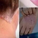 Señales del Papiloma Humano que Debes Saber y Tomar Mucho en Cuenta