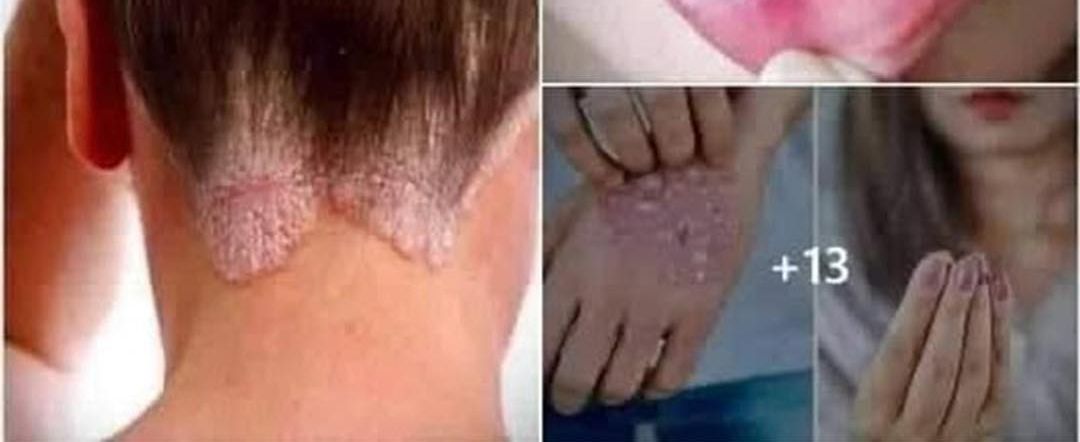 Verrugas Genitales