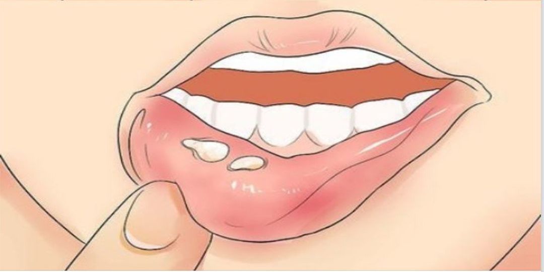 Herpes labial