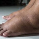 ¡Adiós a los pies hinchados! Causas comunes y soluciones efectivas para aliviar la hinchazón