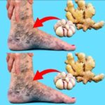 Mezcla Natural para Decir Adiós a las Varices: Un Remedio Casero Efectivo