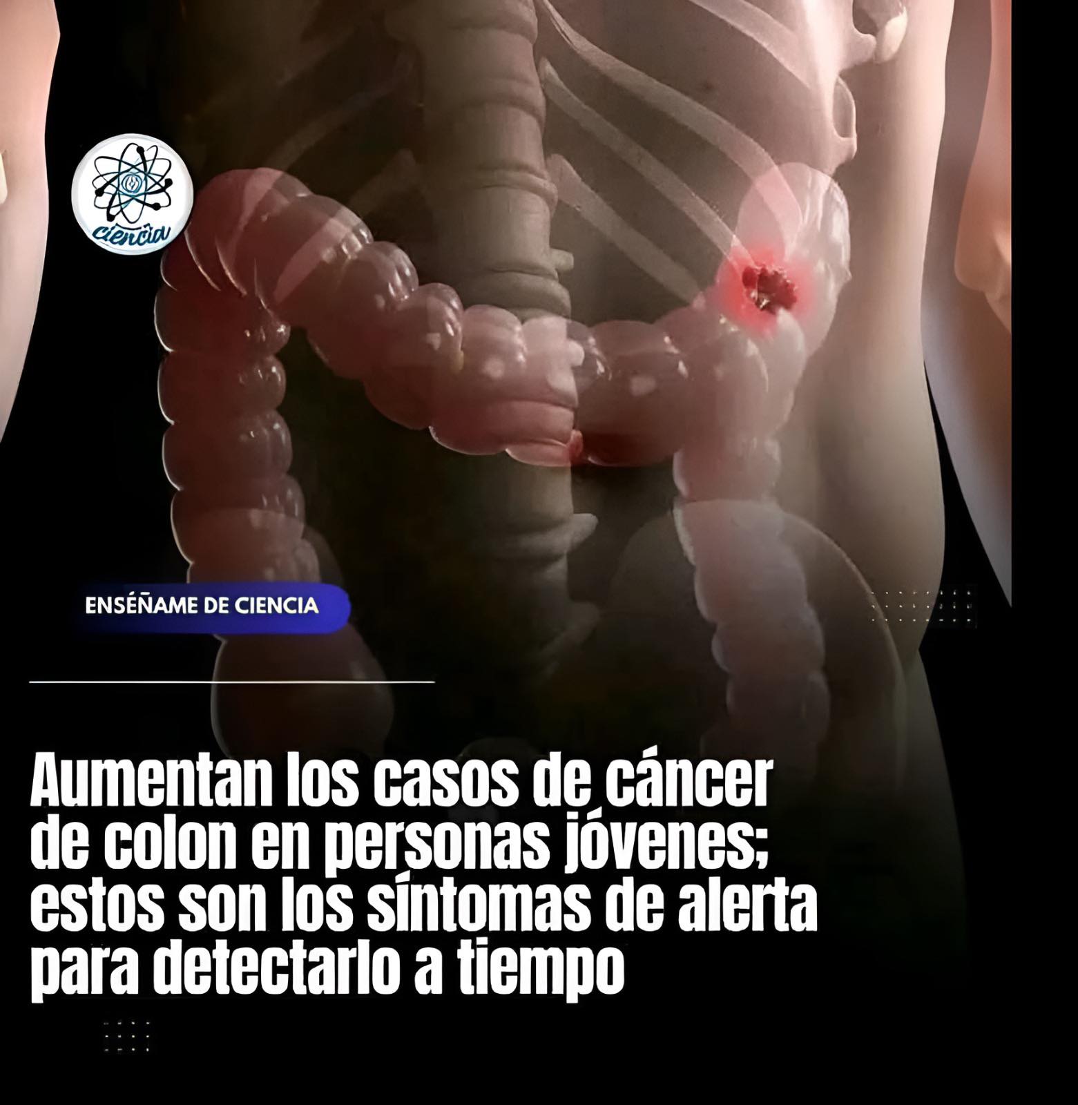 Síntomas desconocidos del cáncer de colon