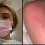 Cuando la Picazón Se Confunde con Alergia: Una Historia Real
