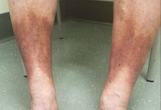 Hiperpigmentación en las piernas debido a insuficiencia venosa crónica