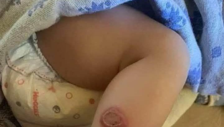 Infección cutánea en un niño