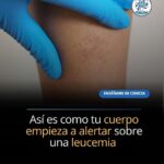 Síntomas que Alertan Sobre Cáncer en la Sangre: ¡No los Pases por Alto!