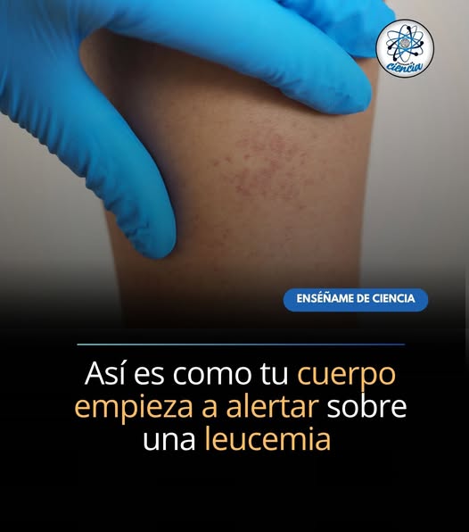 Síntomas del cáncer en la sangre