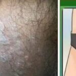 Tiña Inguinal: Todo lo que Necesitas Saber Sobre Esta Infección por Hongos