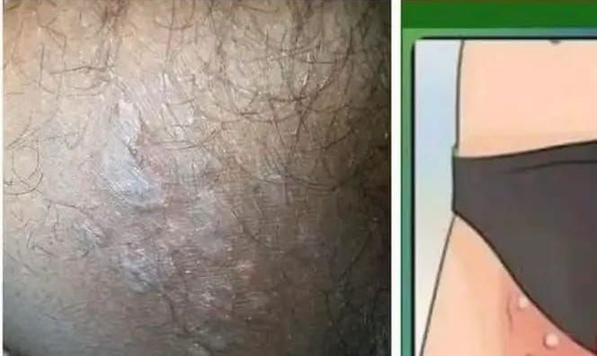 Tiña Inguinal