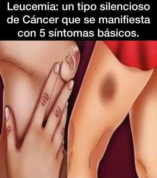 Síntomas de leucemia