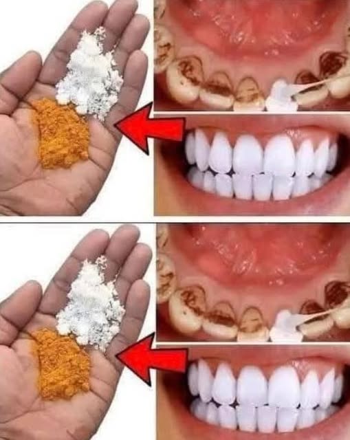 Blanqueamiento Dental Efectivo