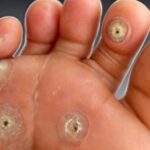 Elimina el Ojo de Pescado con Esta Receta Casera Efectiva