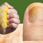 Eliminación de Hongos en las Uñas: Tratamiento 100% Natural para los Hongos en las Uñas de los Pies
