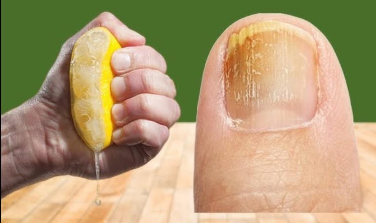 Remedios Naturales para Hongos en las Uñas