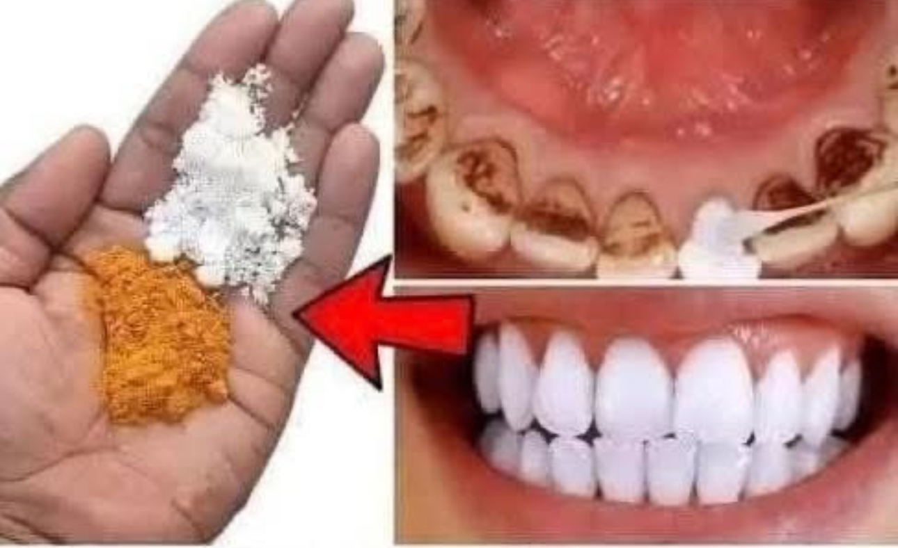 Técnica de blanqueamiento dental en 2 minutos