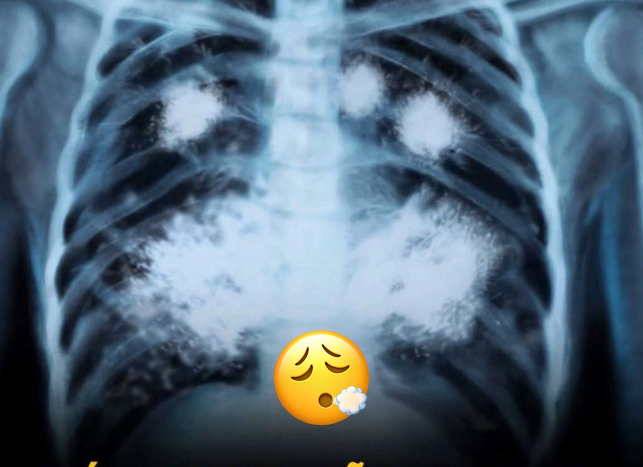 Impacto del vapeo en los pulmones