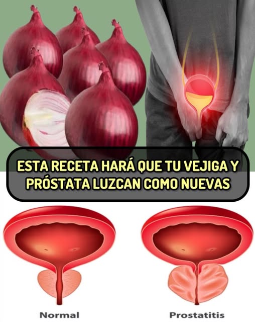 Cebolla y Salud Urológica
