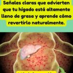 Todo lo que Necesitas Saber Sobre el Hígado Graso: Síntomas, Prevención y Remedios Naturales