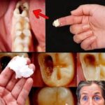 Cómo Reparar una Caries de Forma Natural: Consejos Efectivos