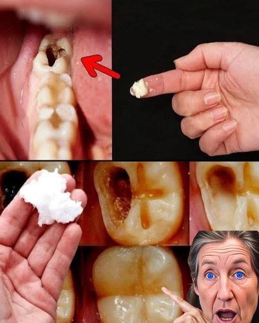 Consejos para reparar caries