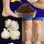Remedios Naturales para el Dolor de Piernas: Ajo y Clavo Dulce