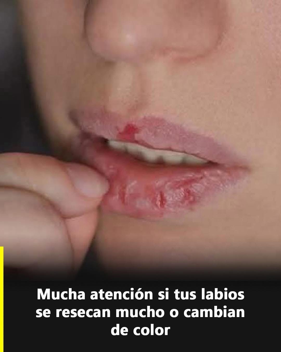 Labios secos y agrietados